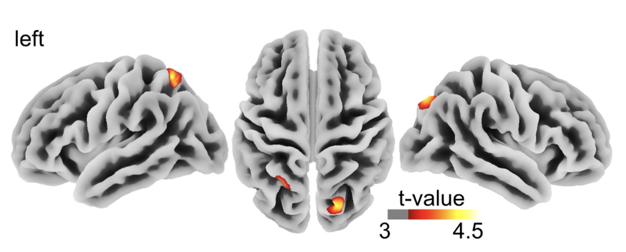 Changes in brain structure in subjects with resistance to thyroid hormone due to THRB mutations.