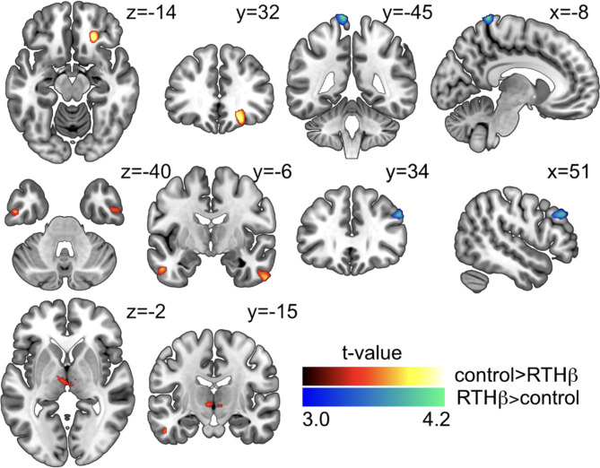 Changes in brain structure in subjects with resistance to thyroid hormone due to THRB mutations.