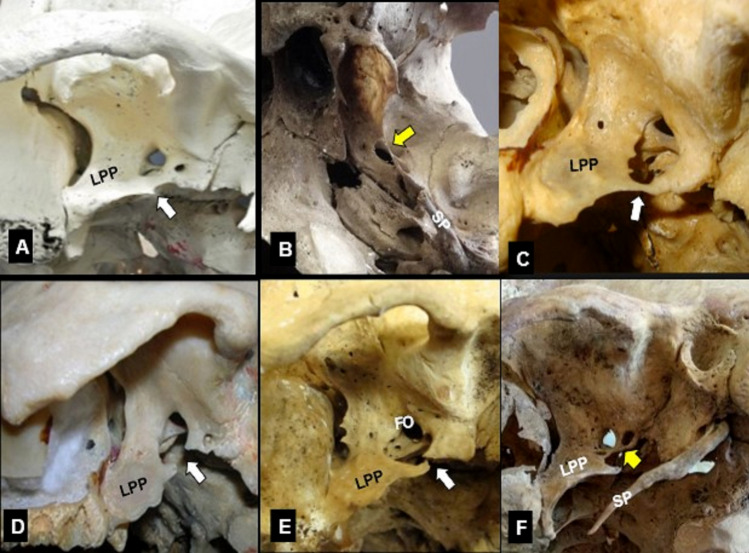 A morphological study on the sphenoid bone ligaments' ossification pattern.