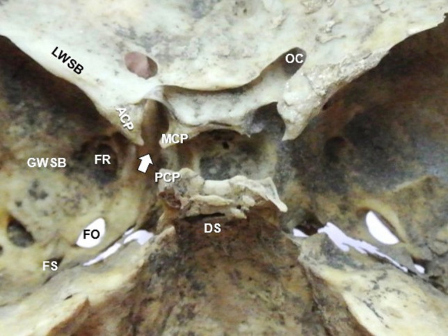 A morphological study on the sphenoid bone ligaments' ossification pattern.