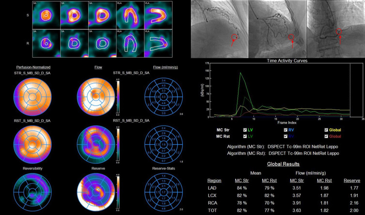 A Comparison of Dynamic SPECT Coronary Flow Reserve with TIMI Frame Count in the Treatment of Non-Obstructive Epicardial Coronary Patients.