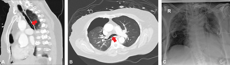 Aspiration of a Blister Pack Tablet with Tracheal Obstruction and Perforation: Emergency Tracheal Repair with Extracorporeal Membrane Oxygenation Support.