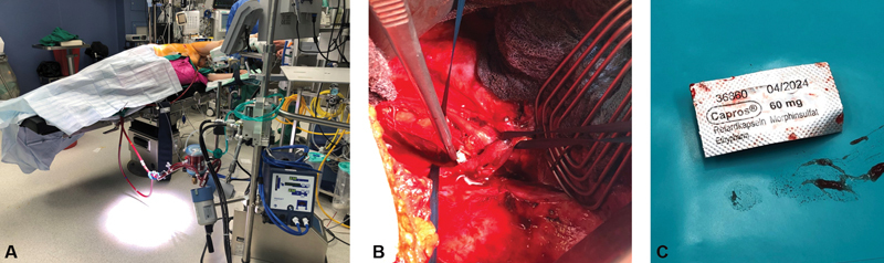 Aspiration of a Blister Pack Tablet with Tracheal Obstruction and Perforation: Emergency Tracheal Repair with Extracorporeal Membrane Oxygenation Support.