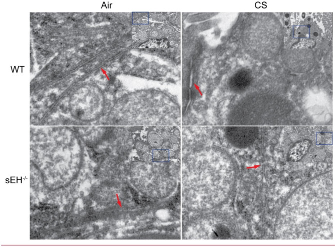 Soluble epoxide hydrolase deficiency attenuates airway inflammation in COPD via IRE1α/JNK/AP-1 signaling pathway.