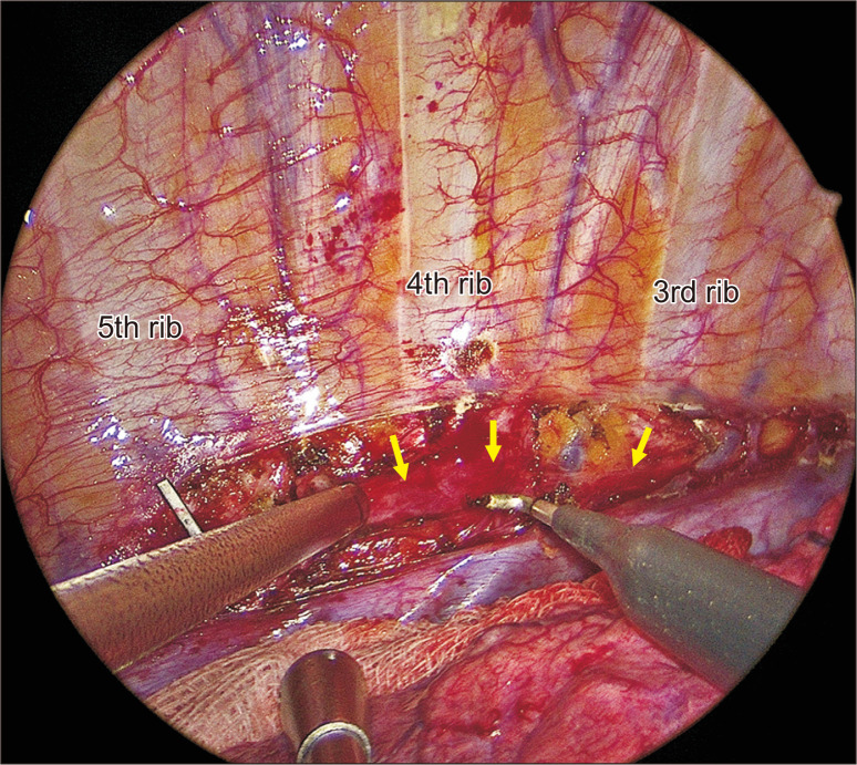 Bilateral Cardiac Sympathetic Denervation as a Safe Therapeutic Option for Ventricular Arrhythmias.