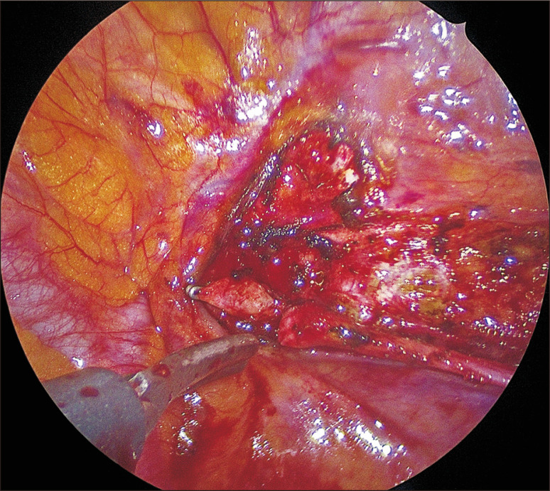 Bilateral Cardiac Sympathetic Denervation as a Safe Therapeutic Option for Ventricular Arrhythmias.