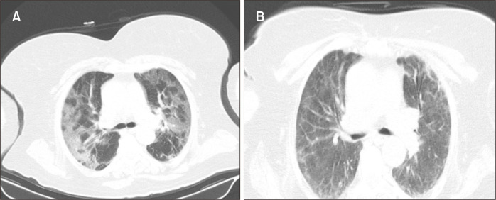 Multiple Arterial Thrombosis after COVID-19: A Case Report.