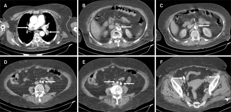 Multiple Arterial Thrombosis after COVID-19: A Case Report.