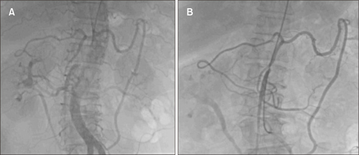 Multiple Arterial Thrombosis after COVID-19: A Case Report.