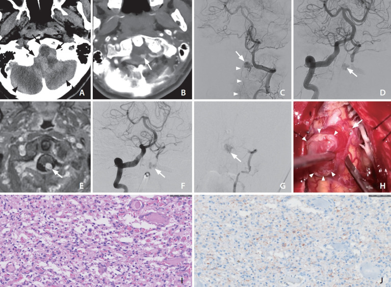 Ruptured Medullary Hemangioblastoma Mimicking a Craniocervical Junction Dural Arteriovenous Fistula with a Pseudoaneurysm.