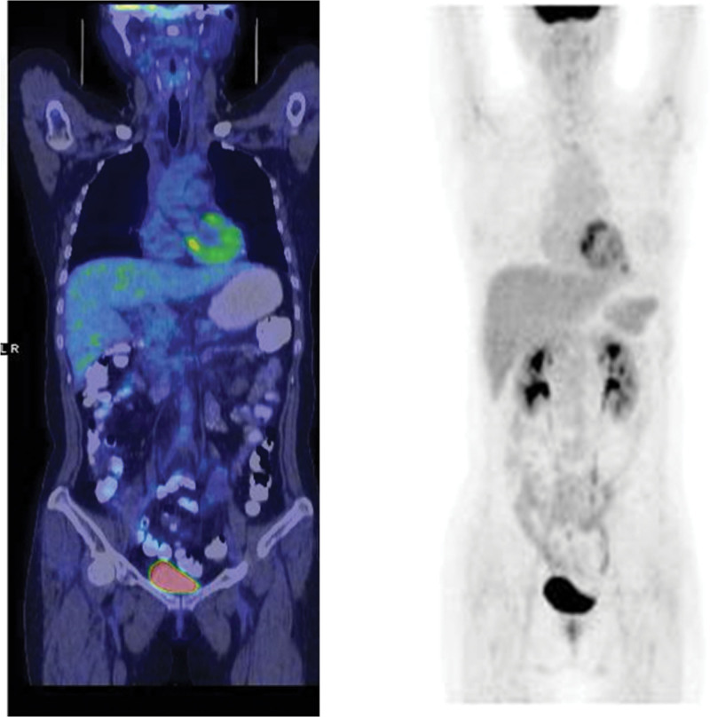 Acute myeloid leukemia relapse after allogeneic hematopoietic stem cell transplantation presenting as pericardial effusion.