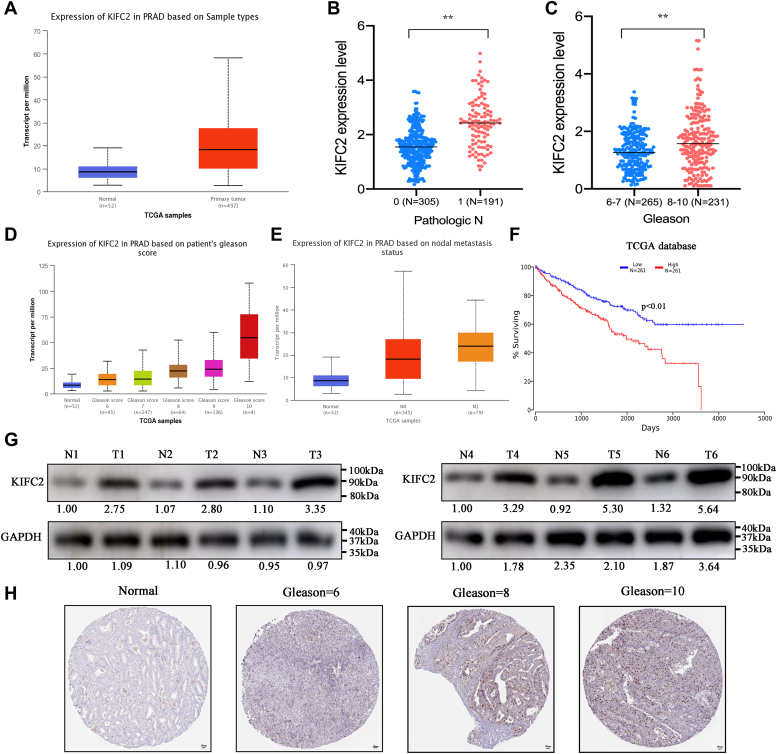 The kinesin-14 family motor protein KIFC2 promotes prostate cancer progression by regulating p65.