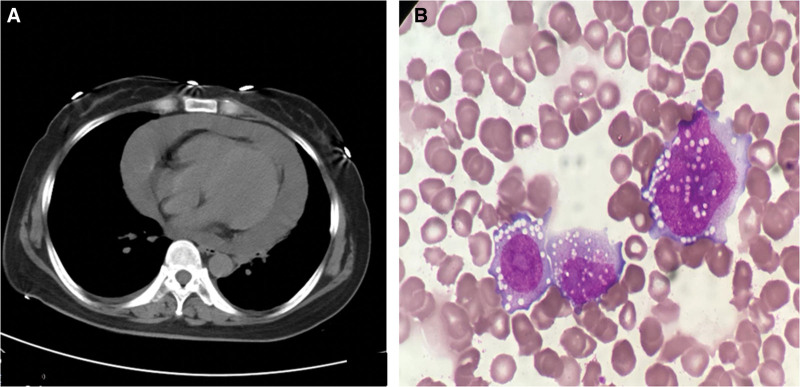 Acute myeloid leukemia relapse after allogeneic hematopoietic stem cell transplantation presenting as pericardial effusion.