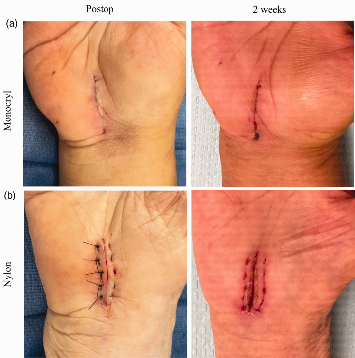 Prospective randomized controlled trial comparing the effect of Monocryl versus nylon sutures on patient- and observer-assessed outcomes following carpal tunnel surgery.