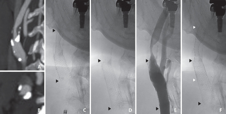 Delayed Migration of Tapered Open-Cell Design Carotid Stent: A Case Report.