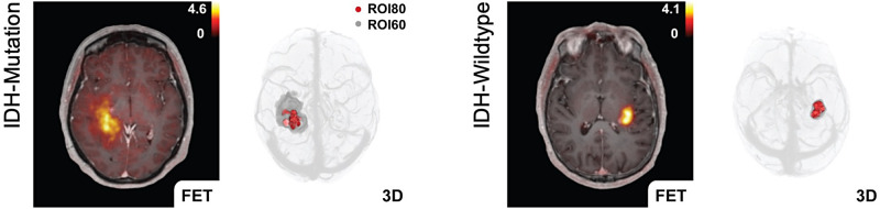 Predictive IDH Genotyping Based on the Evaluation of Spatial Metabolic Heterogeneity by Compartmental Uptake Characteristics in Preoperative Glioma Using <sup>18</sup>F-FET PET.