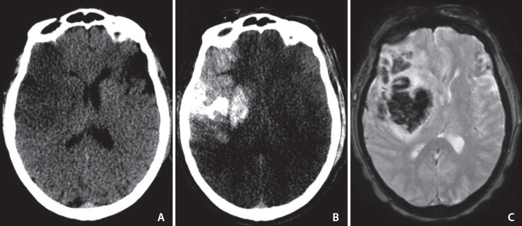 Low Levels of Low-Density Lipoprotein Cholesterol Increase the Risk of Post-Thrombectomy Delayed Parenchymal Hematoma.