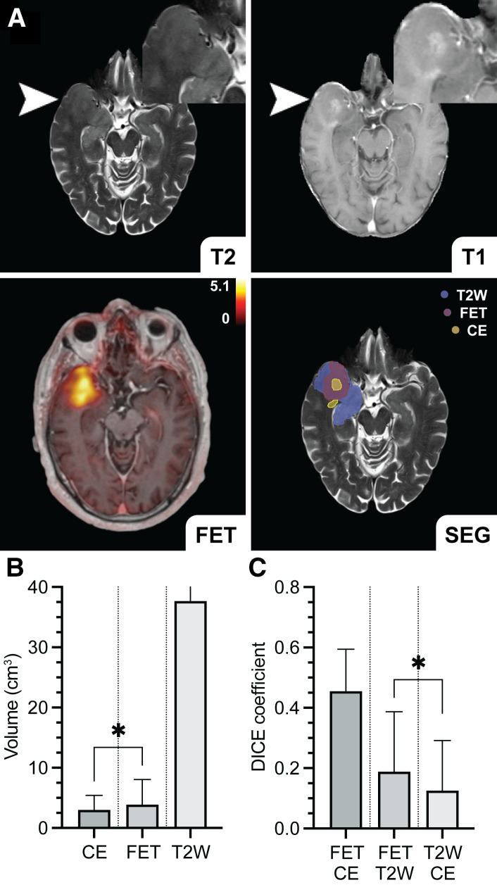 Predictive IDH Genotyping Based on the Evaluation of Spatial Metabolic Heterogeneity by Compartmental Uptake Characteristics in Preoperative Glioma Using <sup>18</sup>F-FET PET.