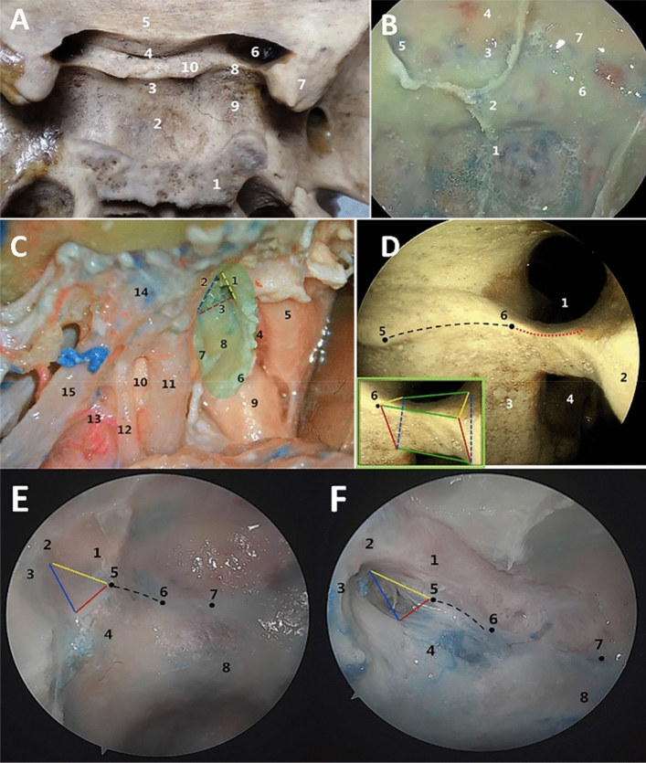 Endoscopic cadaveric analysis of the origin of the ophthalmic artery.