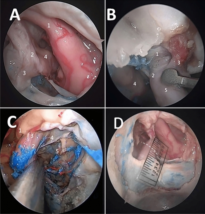 Endoscopic cadaveric analysis of the origin of the ophthalmic artery.