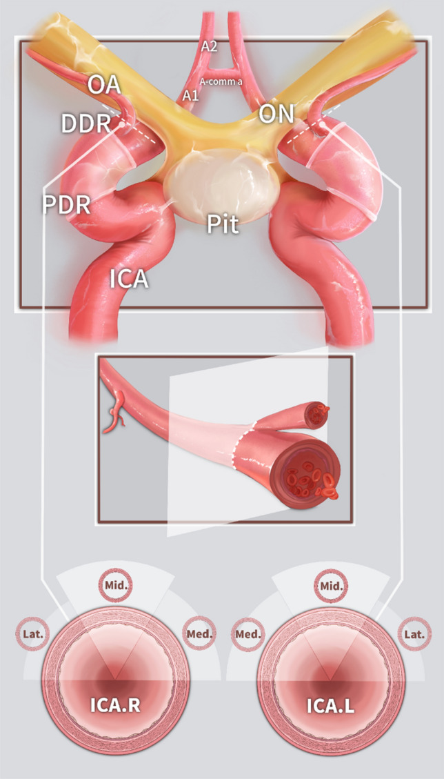 Endoscopic cadaveric analysis of the origin of the ophthalmic artery.