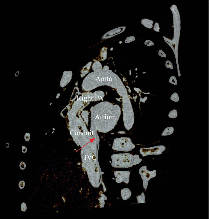 An unusual cause of cyanosis after intra-extra cardiac Fontan procedure: anastomotic leakage between conduit and inferior vena cava.