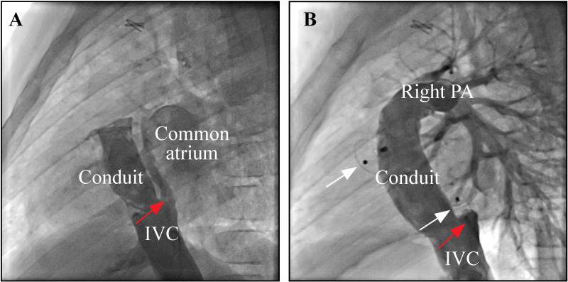 An unusual cause of cyanosis after intra-extra cardiac Fontan procedure: anastomotic leakage between conduit and inferior vena cava.