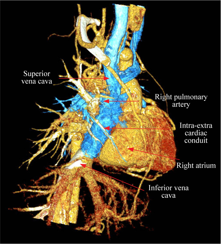 An unusual cause of cyanosis after intra-extra cardiac Fontan procedure: anastomotic leakage between conduit and inferior vena cava.