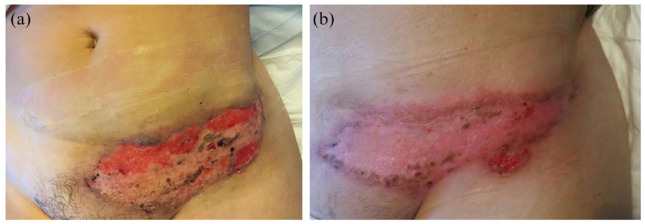 Pyoderma gangrenosum in ulcerative colitis patient treated with vedolizumab: adsorptive granulocyte/monocyte apheresis as a new therapeutic option refractory cases - a case report and literature review.