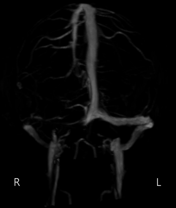 Cerebral venous sinus thrombosis secondary to acute cytomegalovirus infection.