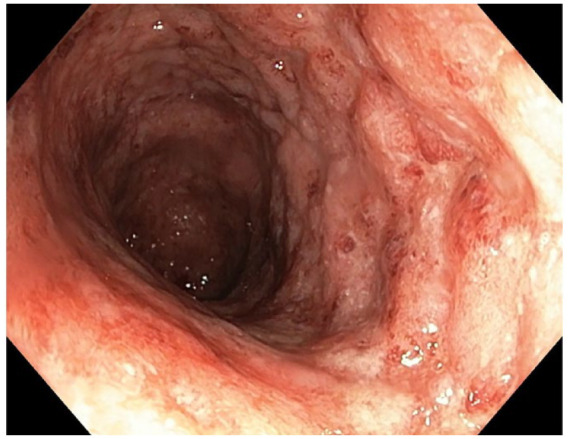 Pyoderma gangrenosum in ulcerative colitis patient treated with vedolizumab: adsorptive granulocyte/monocyte apheresis as a new therapeutic option refractory cases - a case report and literature review.