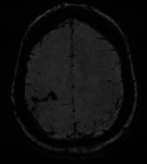 Cerebral venous sinus thrombosis secondary to acute cytomegalovirus infection.