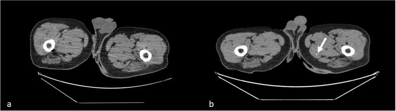 Non-target embolic events during prostatic embolization with ethylene vinyl alcohol copolymer (EVOH).