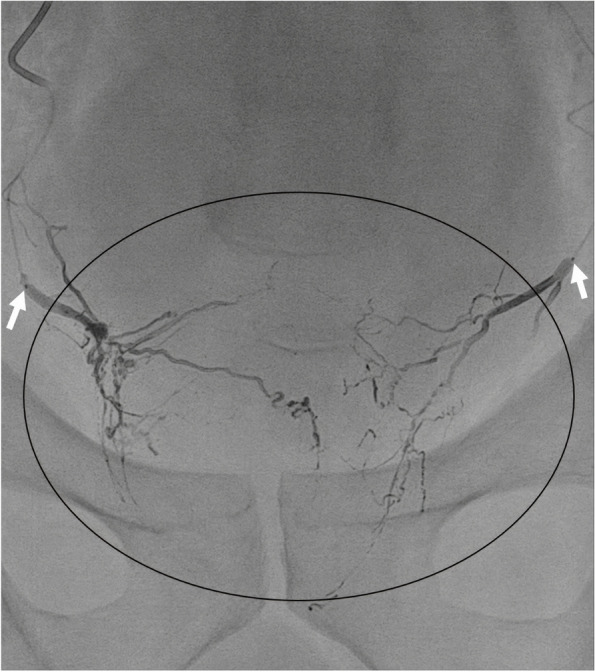 Non-target embolic events during prostatic embolization with ethylene vinyl alcohol copolymer (EVOH).