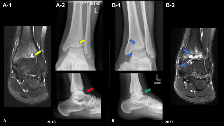 Glanzmann Thrombasthenia Associated with Siderotic Synovitis and Arthropathy: A Case Report.