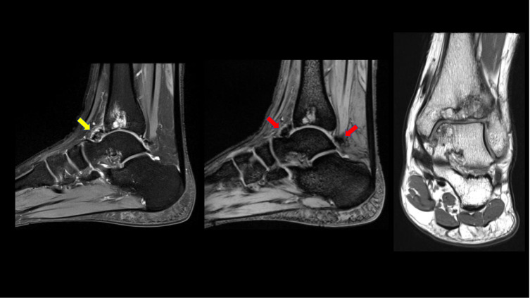 Glanzmann Thrombasthenia Associated with Siderotic Synovitis and Arthropathy: A Case Report.