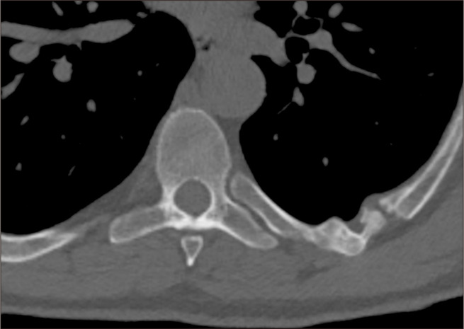 Operative Resection of a Chronic Flail Chest Nonunion Revealing Septic Pseudarthrosis: A Case Report.