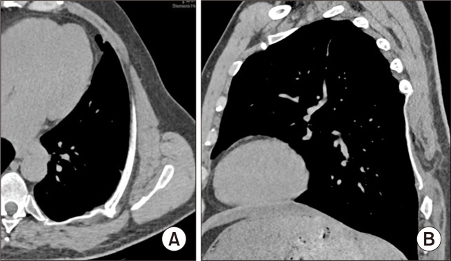 Operative Resection of a Chronic Flail Chest Nonunion Revealing Septic Pseudarthrosis: A Case Report.