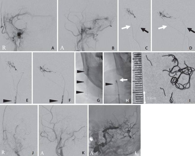 Hairball-Like Migration of "Onyx Threads" into the Draining Vein during Transarterial Embolization of a Dural Arteriovenous Fistula: A Case Report and Experimental Validation.