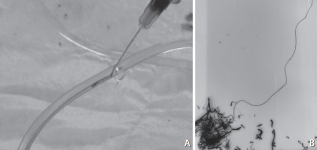 Hairball-Like Migration of "Onyx Threads" into the Draining Vein during Transarterial Embolization of a Dural Arteriovenous Fistula: A Case Report and Experimental Validation.