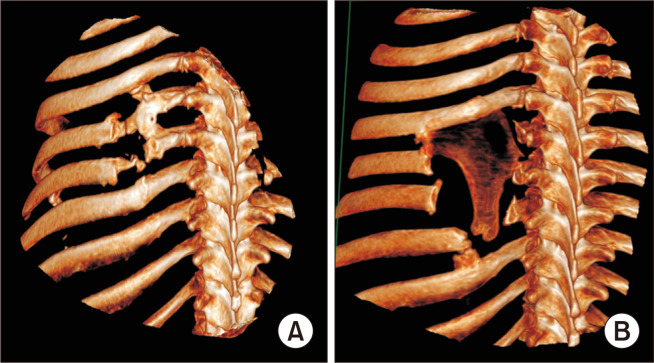 Operative Resection of a Chronic Flail Chest Nonunion Revealing Septic Pseudarthrosis: A Case Report.