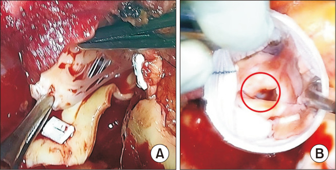 Valve-Sparing Neo-Aortic Root Replacement for Neo-Aortic Root Dilatation 20 Years after Arterial Switch Operation for Transposition of the Great Arteries: A Case Report.