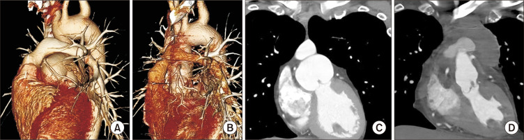 Valve-Sparing Neo-Aortic Root Replacement for Neo-Aortic Root Dilatation 20 Years after Arterial Switch Operation for Transposition of the Great Arteries: A Case Report.