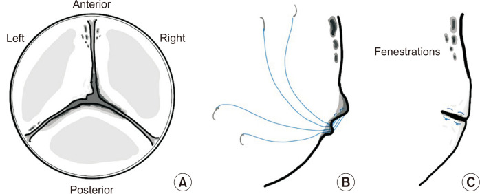 Valve-Sparing Neo-Aortic Root Replacement for Neo-Aortic Root Dilatation 20 Years after Arterial Switch Operation for Transposition of the Great Arteries: A Case Report.