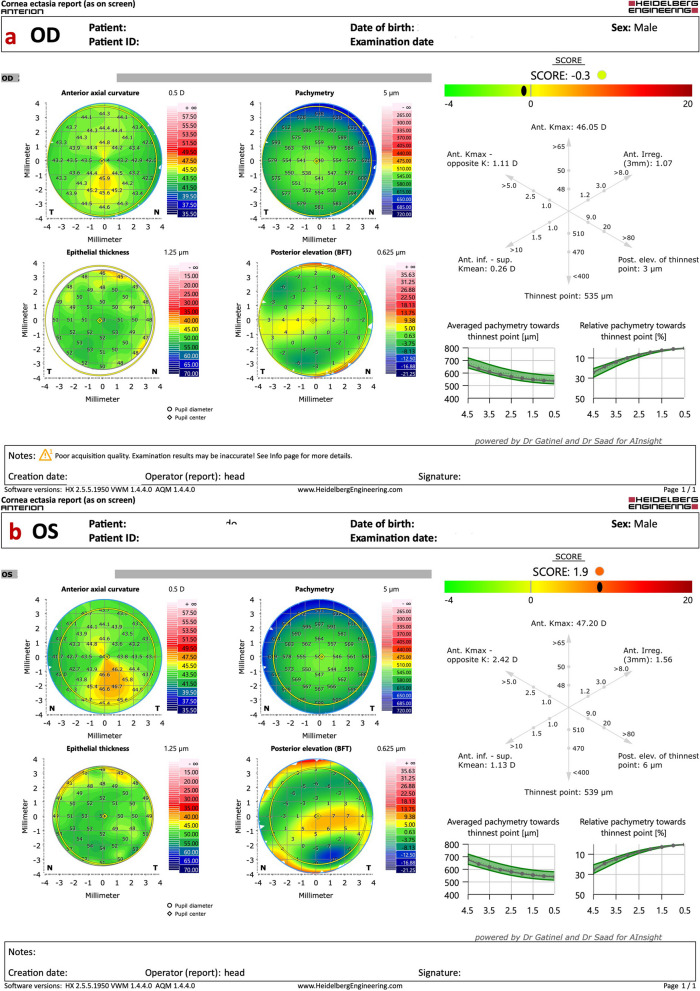 Multimodal diagnostics for keratoconus and ectatic corneal diseases: a paradigm shift.