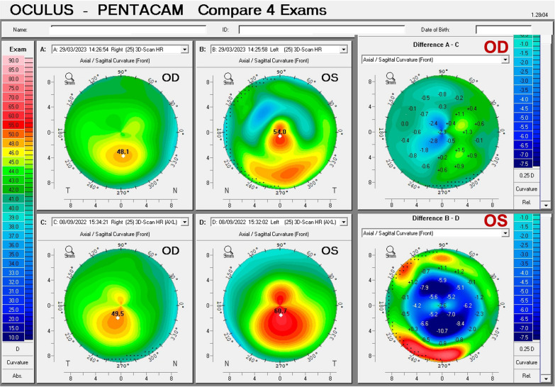 Multimodal diagnostics for keratoconus and ectatic corneal diseases: a paradigm shift.