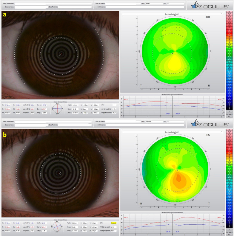 Multimodal diagnostics for keratoconus and ectatic corneal diseases: a paradigm shift.