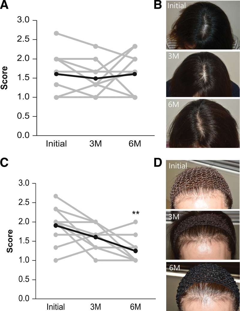 Clinical and phototrichogrammatic evaluation of estradiol replacement therapy on hair growth in postmenopausal Japanese women with female pattern hair loss: a pilot study.