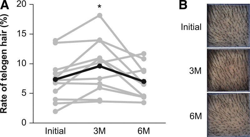 Clinical and phototrichogrammatic evaluation of estradiol replacement therapy on hair growth in postmenopausal Japanese women with female pattern hair loss: a pilot study.