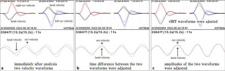 Development of a Prototype Video Head Impulse Test System Using an iPhone for Screening of Peripheral Vestibular Dysfunction.